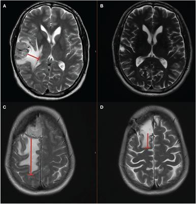 The safety and use of perioperative dexamethasone in the perioperative management of primary sporadic supratentorial meningiomas